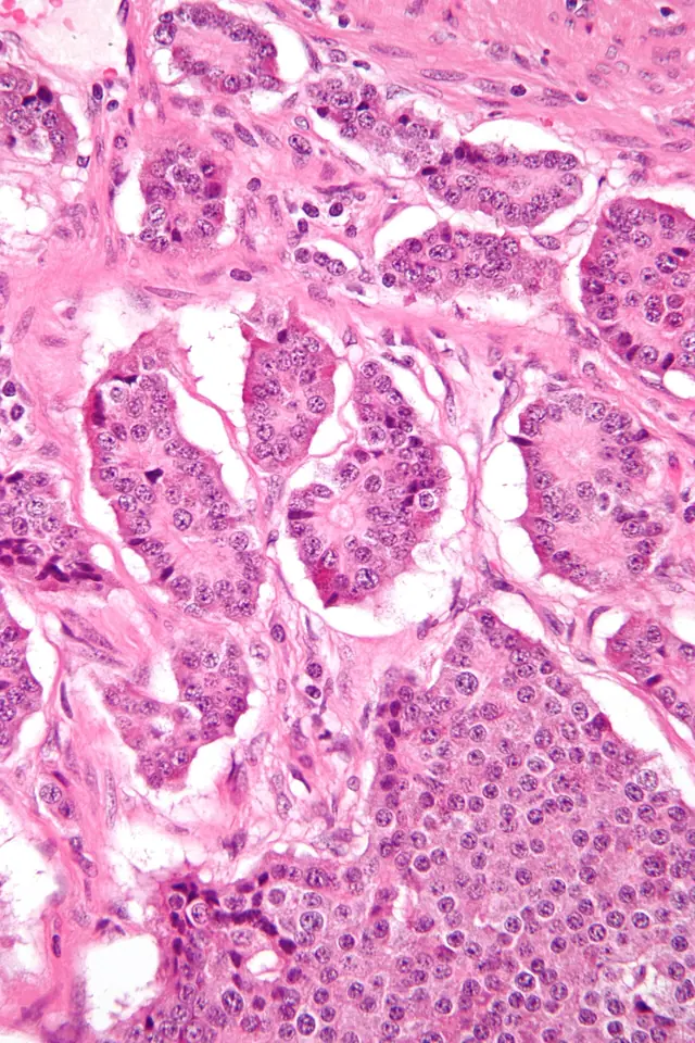 neuro-endocriene tumor - trend visualization